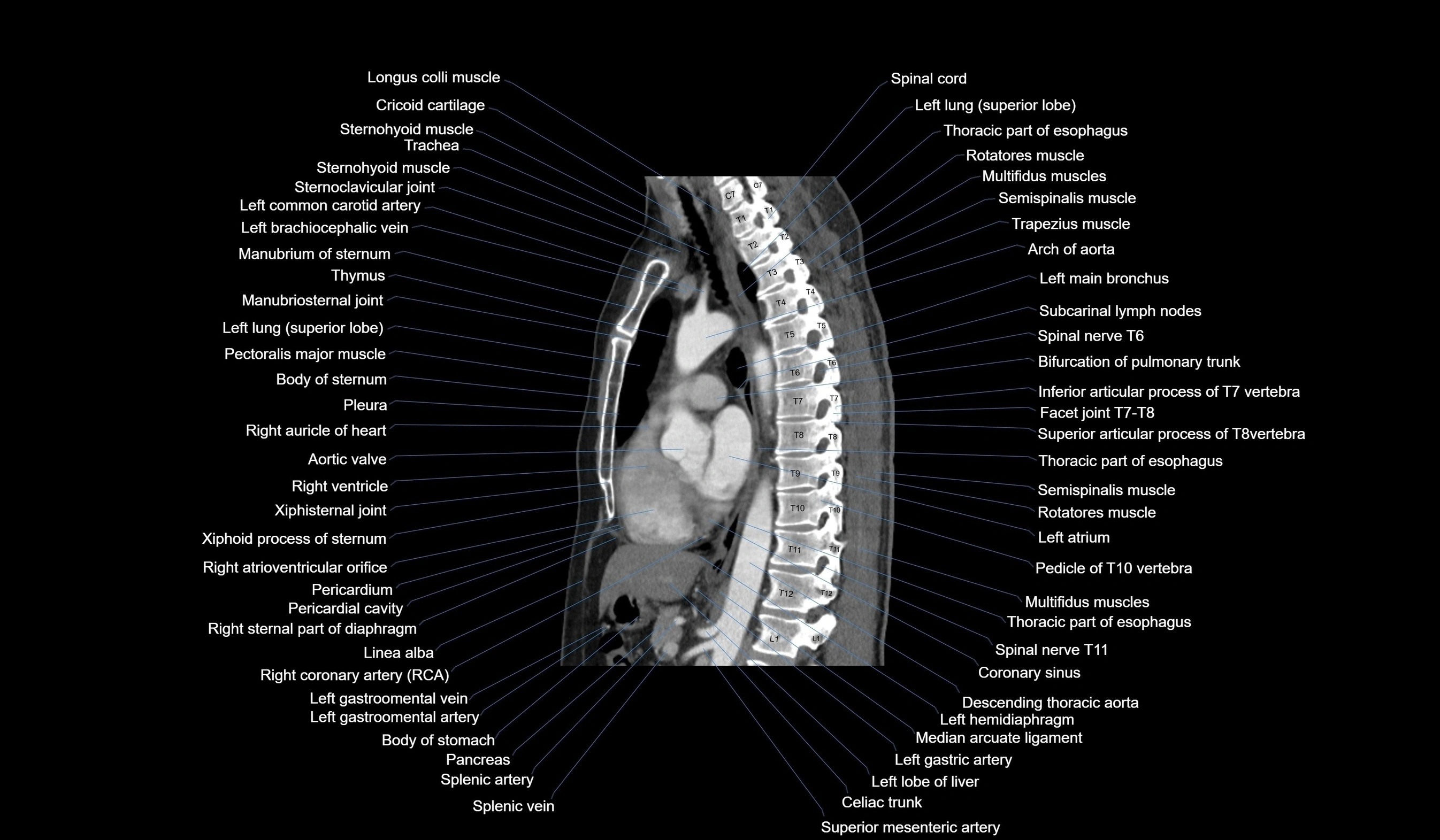 CT chest (thorax) labelled sagittal cross sectional anatomy radiology image-00077.webp